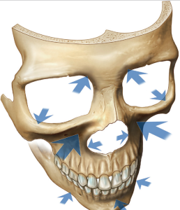 bony resorption areas with aging